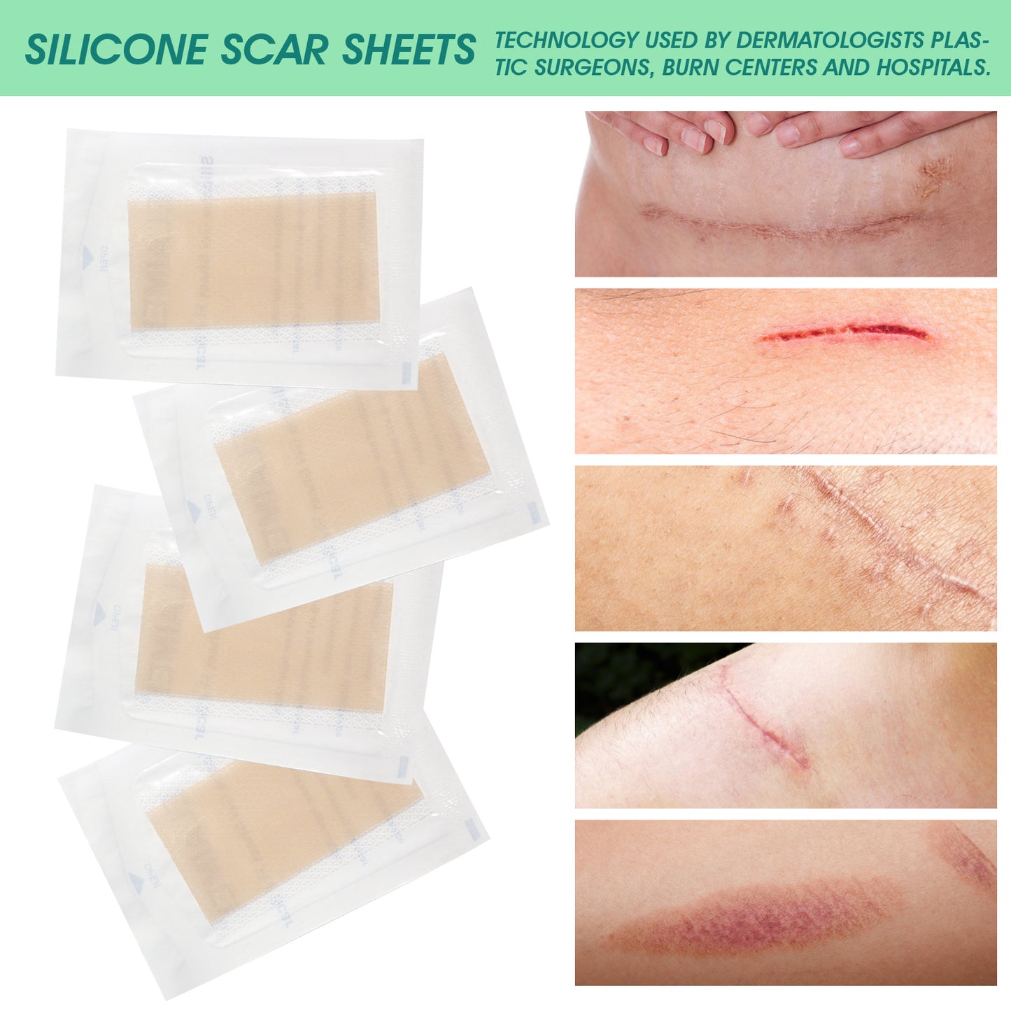 (🎁Hot Sale🎁)SILICONE SCAR SHEETS